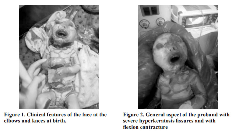 Harlequin Ichthyosis Baby - New Indian Journal of Pediatrics
